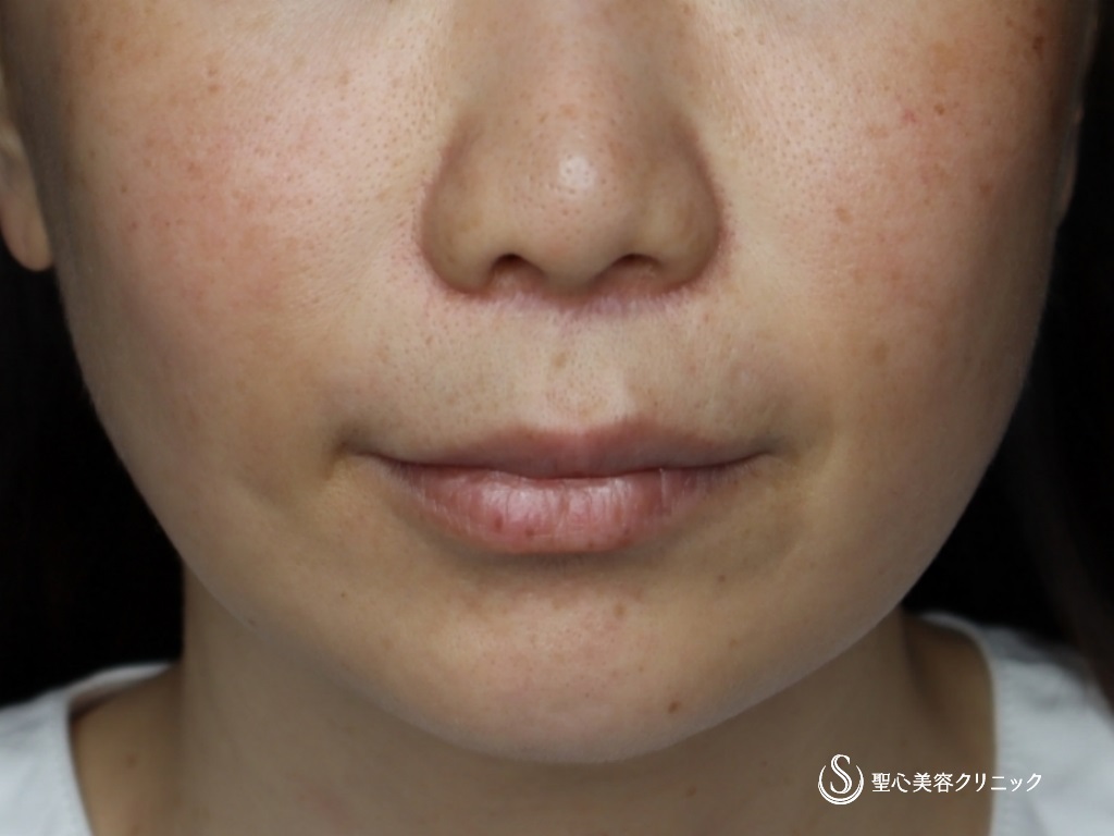 【40代女性・頬、フェイスラインのたるみ】フェイスリフト（リガメント処置+頬あご下ベイザー脂肪吸引）（3ヶ月後） Before 