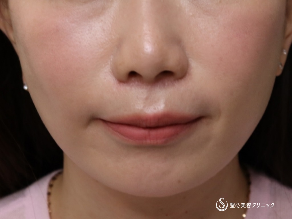 【40代女性・頬、フェイスラインのたるみ】フェイスリフト（リガメント処置+頬あご下ベイザー脂肪吸引）（3ヶ月後） After 