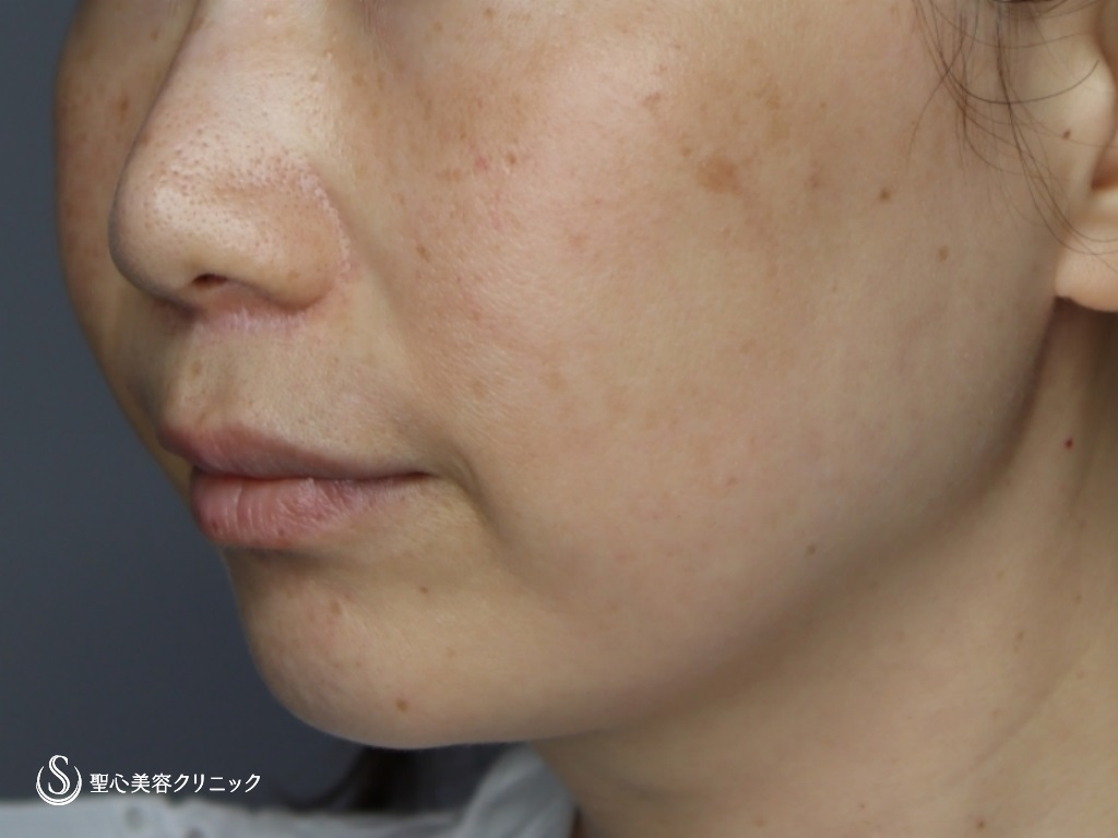 【40代女性・頬、フェイスラインのたるみ】フェイスリフト（リガメント処置+頬あご下ベイザー脂肪吸引）（3ヶ月後） Before 