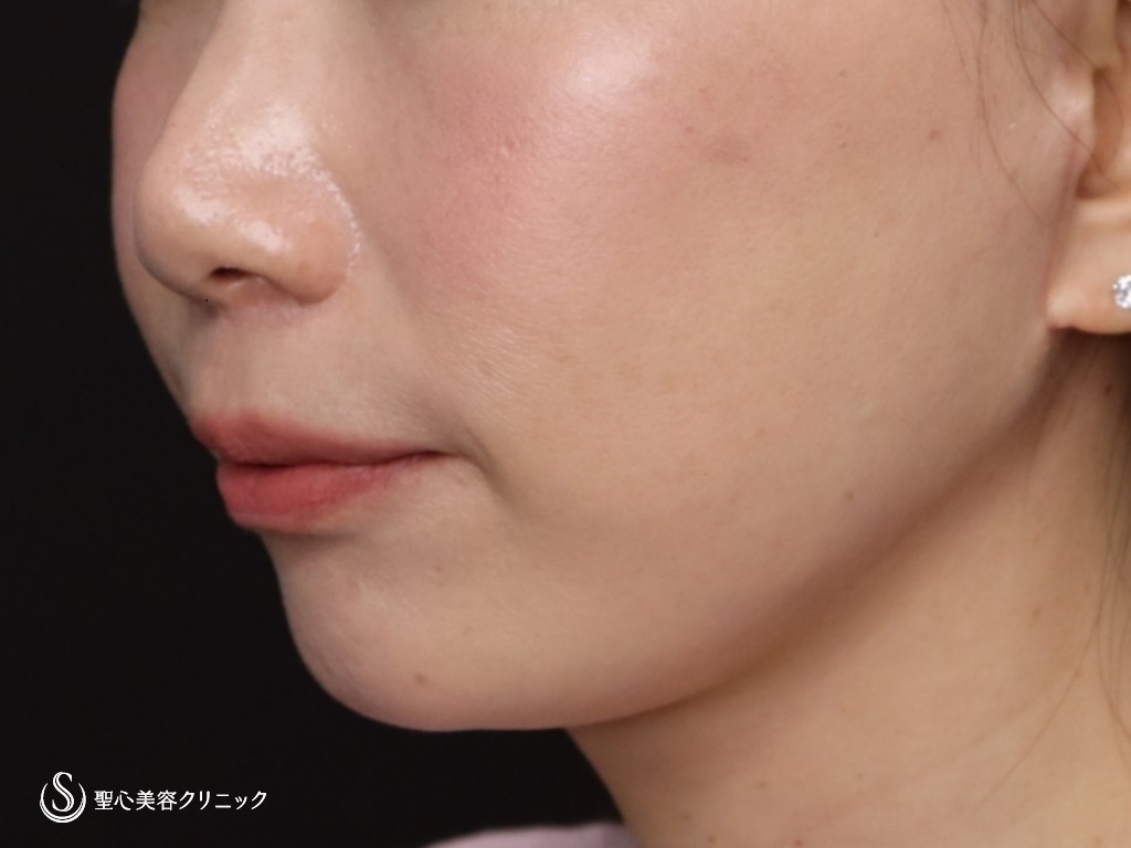 【40代女性・頬、フェイスラインのたるみ】フェイスリフト（リガメント処置+頬あご下ベイザー脂肪吸引）（3ヶ月後） After 
