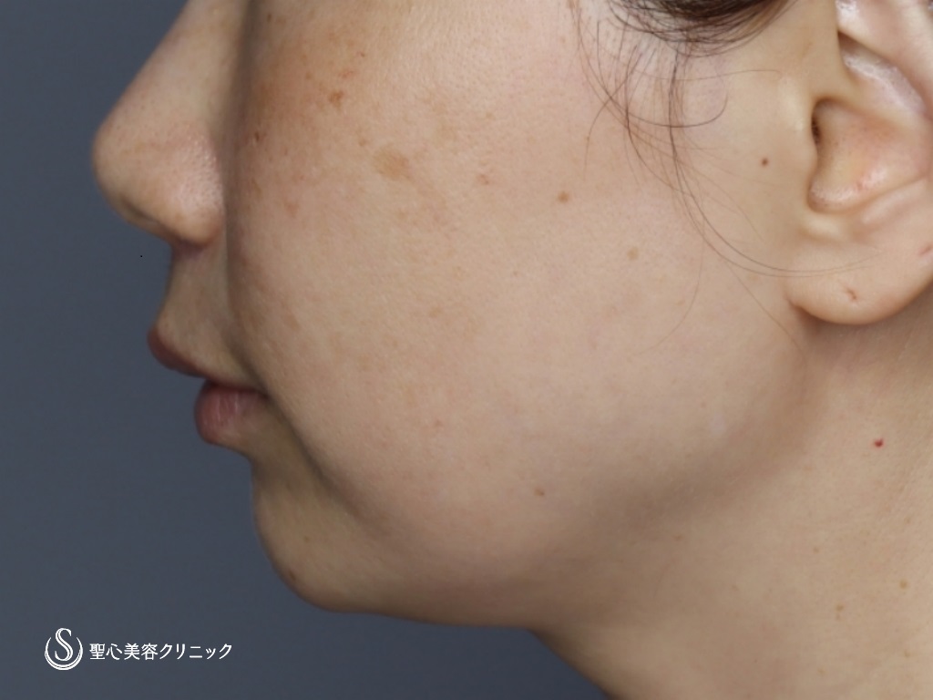 【40代女性・頬、フェイスラインのたるみ】フェイスリフト（リガメント処置+頬あご下ベイザー脂肪吸引）（3ヶ月後） Before 