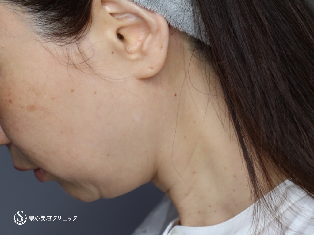 【40代女性・頬、フェイスラインのたるみ】フェイスリフト（リガメント処置+頬あご下ベイザー脂肪吸引）（3ヶ月後） Before 