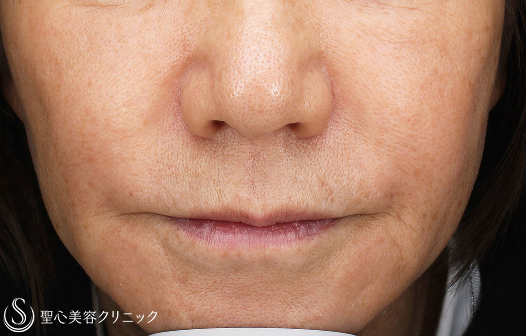 【60代女性・人中の長さ】鼻下短縮術（1年後） Before 