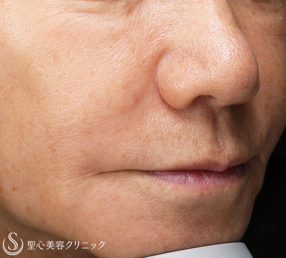 【60代女性・人中の長さ】鼻下短縮術（1年後） Before 