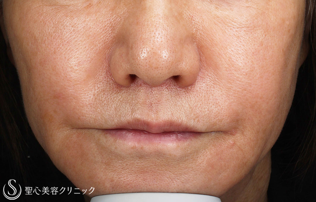 【60代女性・人中の長さ】鼻下短縮術（1年後） After 