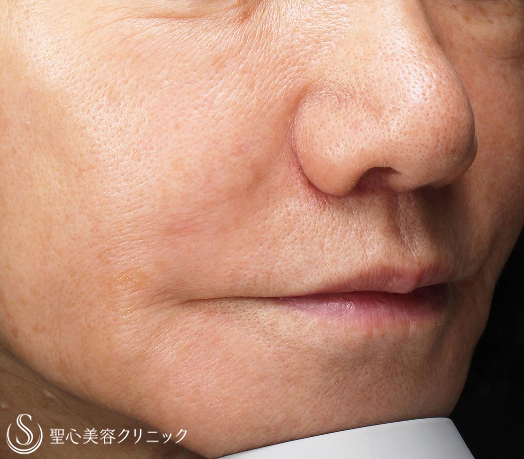 【60代女性・人中の長さ】鼻下短縮術（1年後） After 
