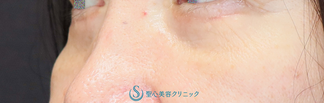 【60代女性・目の下の弛みと膨らみを改善】下眼瞼除皺術・脱脂術（目の下の弛み取り・脂肪取り）（1ヶ月後） After 