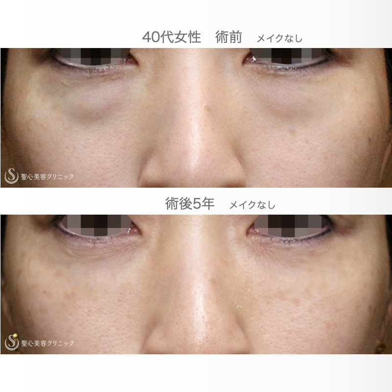 【40代女性・目の下のクマ治療（長期経過）】経結膜下脱脂術＆プレミアムPRP皮膚再生療法（5年後） After 