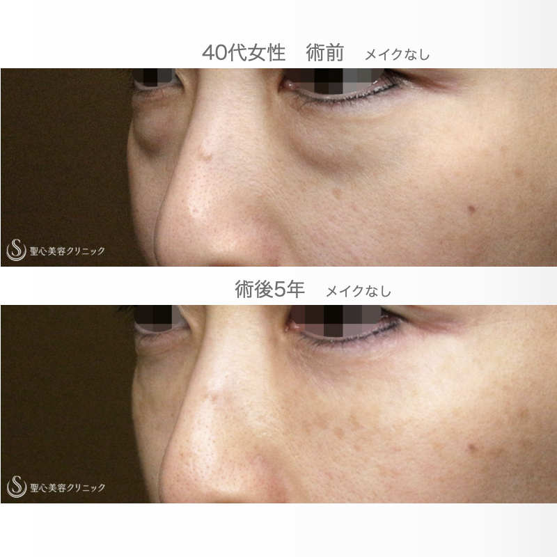 【40代女性・目の下のクマ治療（長期経過）】経結膜下脱脂術＆プレミアムPRP皮膚再生療法（5年後） After 