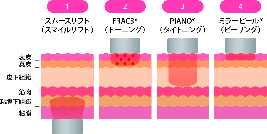 4種類のレーザーについて