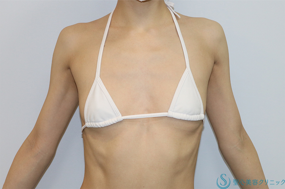 【20代女性　理想のバストへ　豊胸術】モティバ・エルゴノミクス245cc（3か月後） Before 