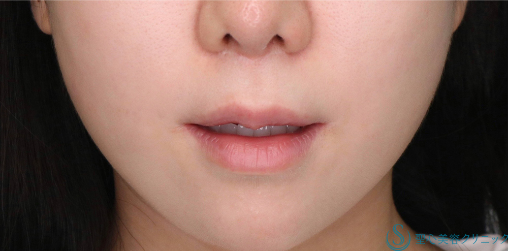 【20代女性・人中をバランスよく短くしたい！！】プレミアムリップリフト（プレミアム人中短縮術）（術後6日・術後1ヶ月） Before 