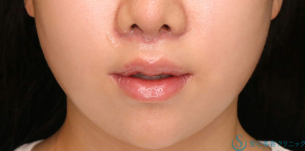 【20代女性・人中をバランスよく短くしたい！！】プレミアムリップリフト（プレミアム人中短縮術）（術後6日・術後1ヶ月） After 