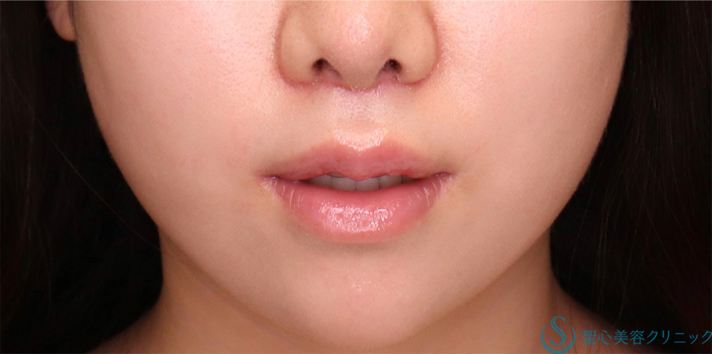 【20代女性・人中をバランスよく短くしたい！！】プレミアムリップリフト（プレミアム人中短縮術）（術後6日・術後1ヶ月） After 