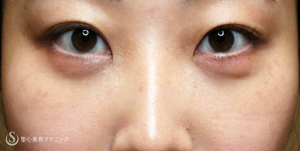 【20代女性・目の下のクマ治療】経結膜下脱脂術・単独（3ヶ月後） After 