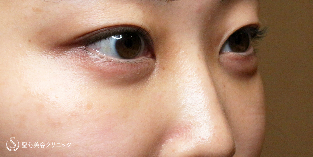 【20代女性・目の下のクマ治療】経結膜下脱脂術・単独（3ヶ月後） After 