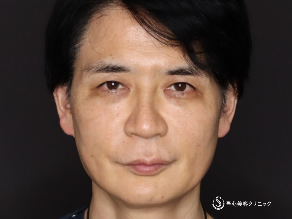 【50代男性・たるみ治療＆予防】アンカーマックス（3週間後） After 