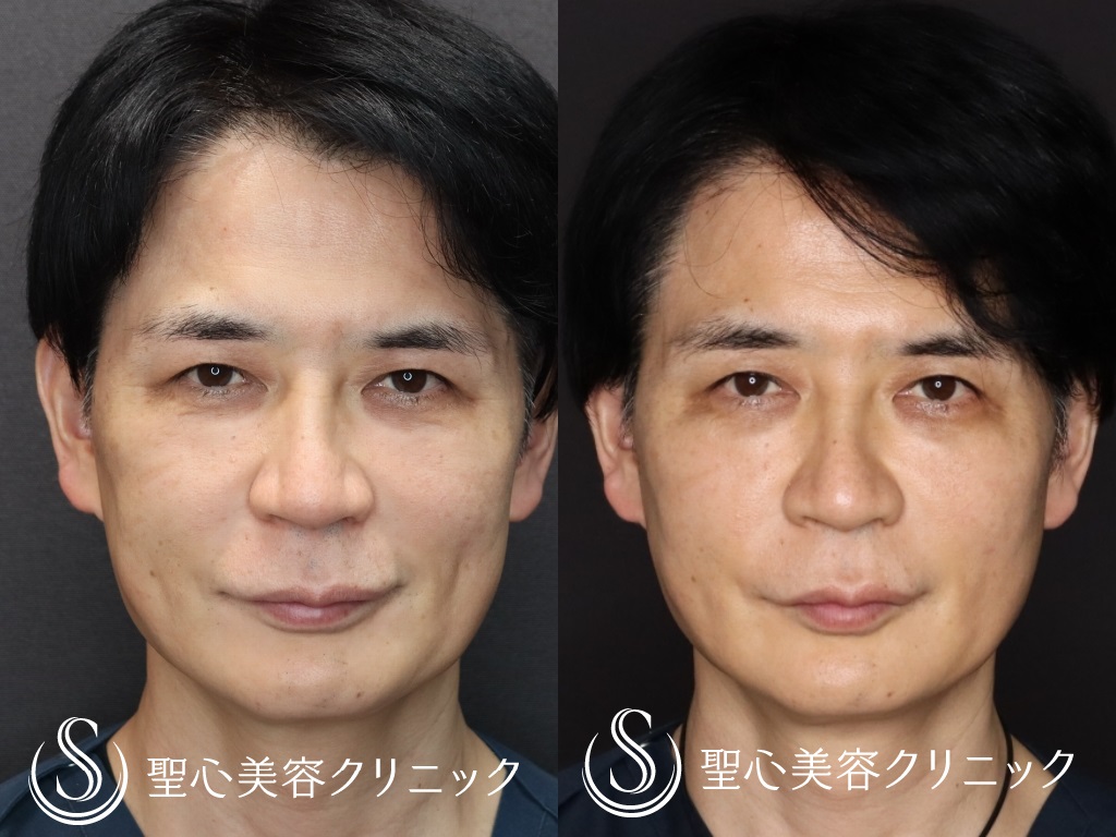 【50代男性・たるみ治療＆予防】アンカーマックス（3週間後） After 