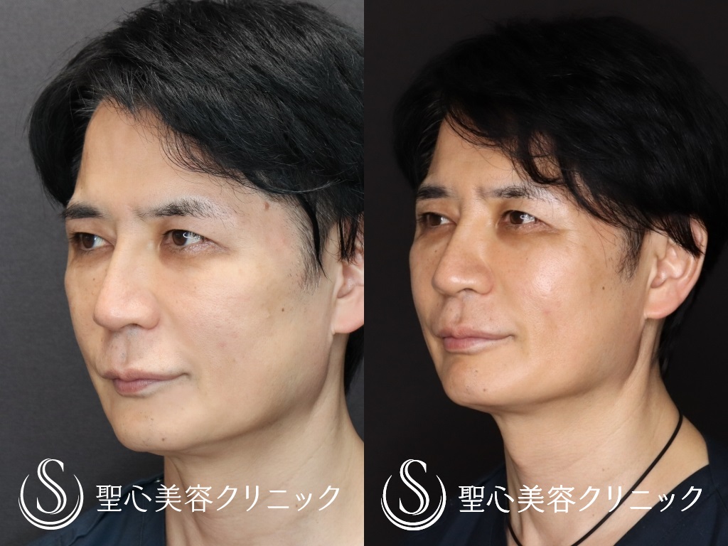 【50代男性・たるみ治療＆予防】アンカーマックス（3週間後） After 