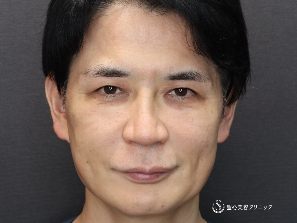 【50代男性・たるみ治療＆予防】アンカーマックス（3週間後） Before 