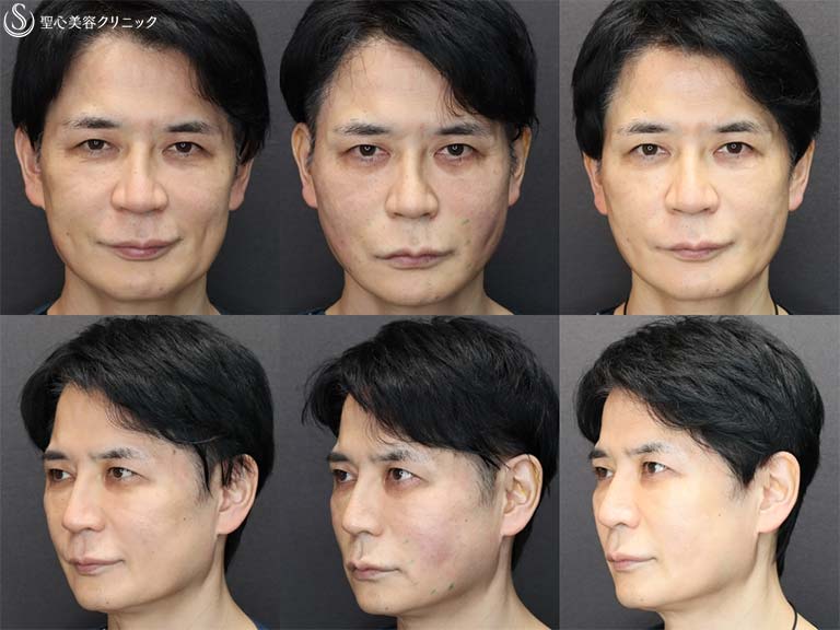 【50代男性・たるみ治療＆予防】アンカーマックス（3週間後） Before 