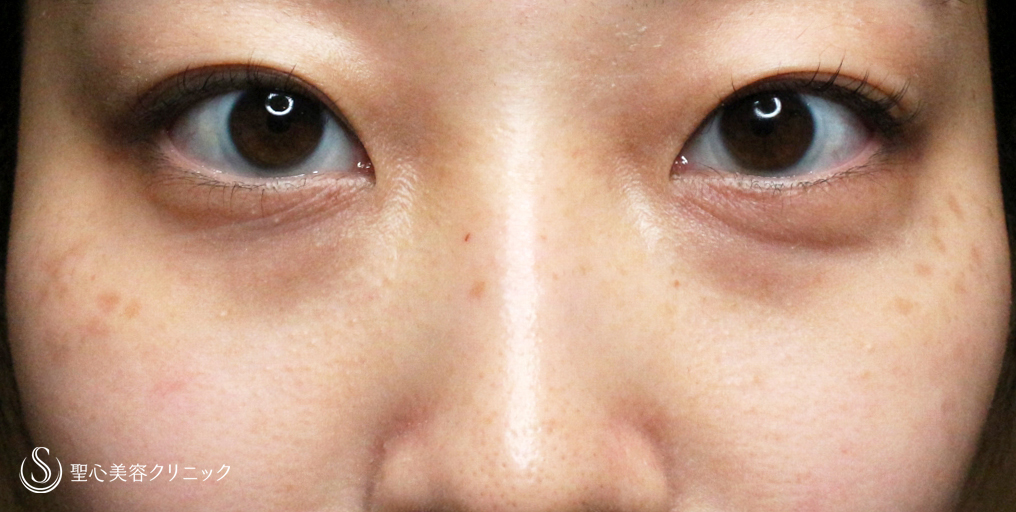 【20代女性・目の下のクマ治療】経結膜下脱脂術・単独（3ヶ月後） Before 