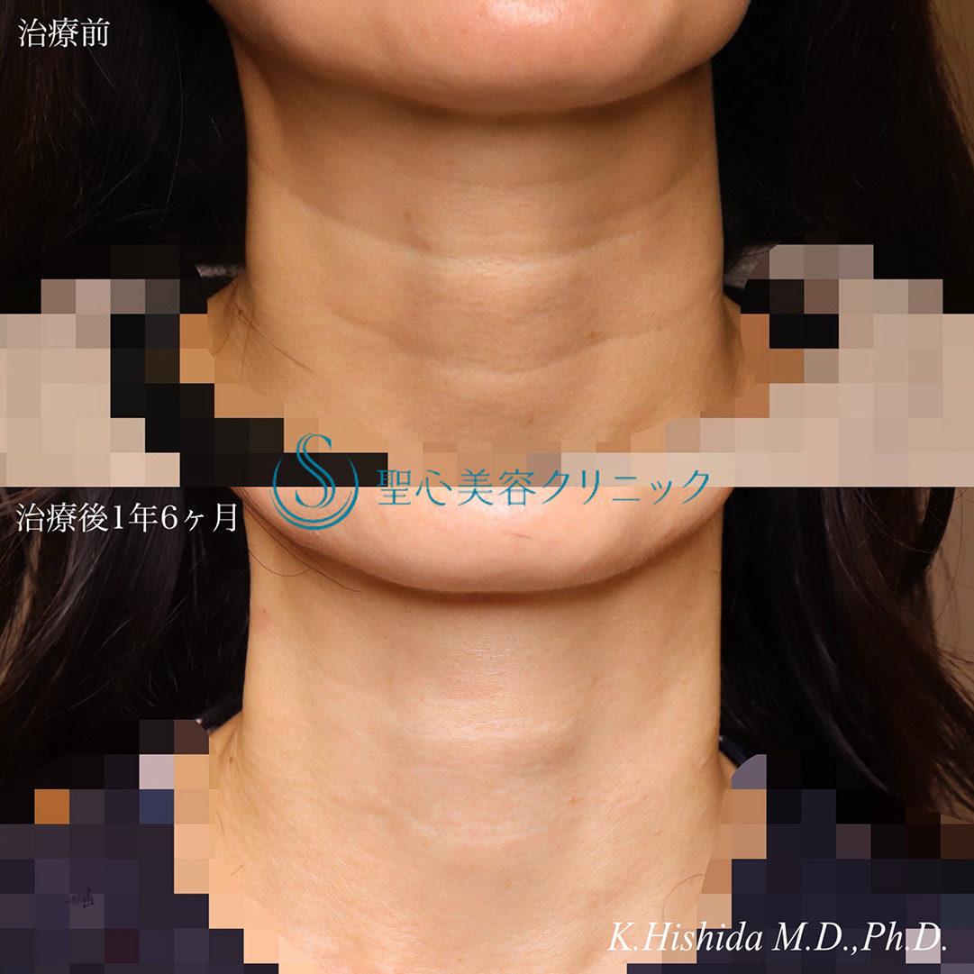 【40代女性・首の横ジワを治したい】プレミアムPRP皮膚再生療法（1年6ヶ月後） After 