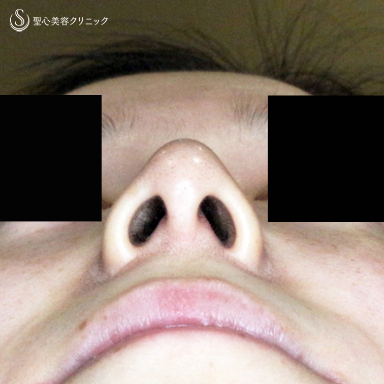 【20代女性・存在感のない「忘れ鼻」へ】小鼻縮小術+α法 ＆ 鼻尖縮小術+α法（4年9ヶ月後） After 