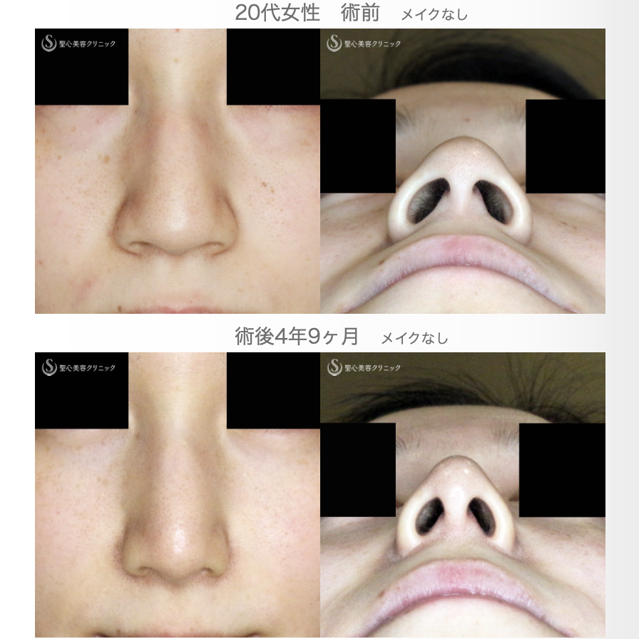【20代女性・存在感のない「忘れ鼻」へ】小鼻縮小術+α法 ＆ 鼻尖縮小術+α法（4年9ヶ月後） After 