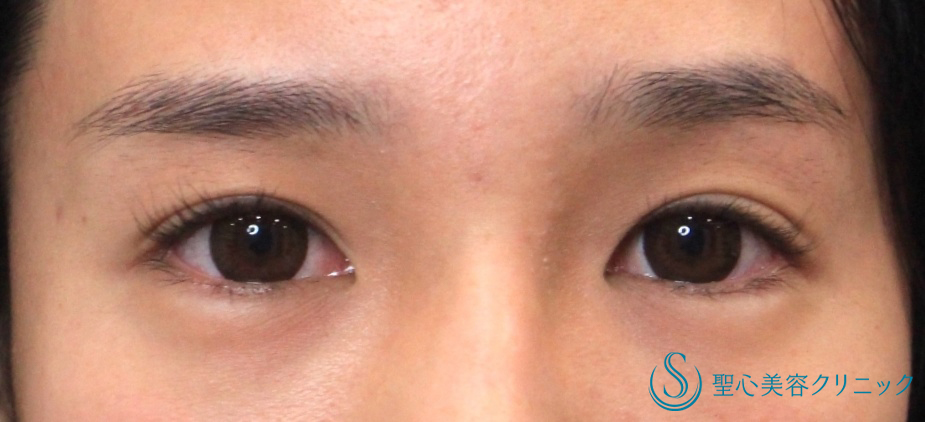 【20代女性・大人っぽい綺麗な平行型に】目頭切開（4年後） Before 
