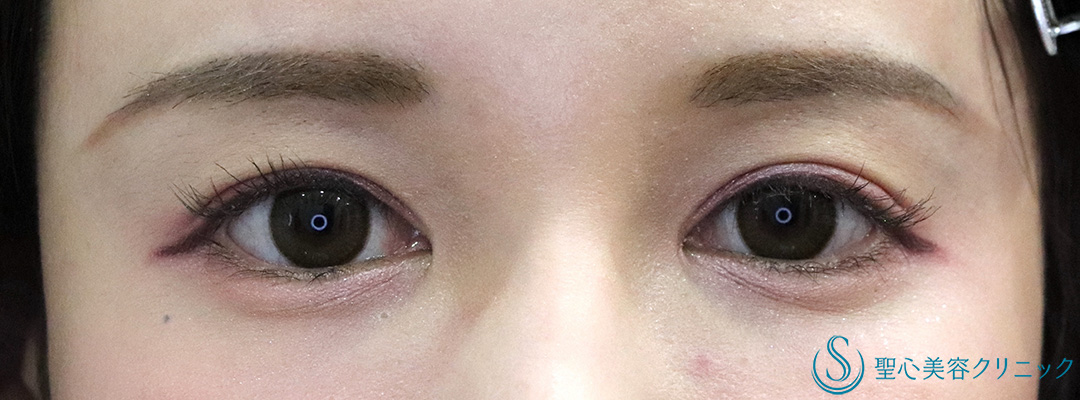 【20代女性・大人っぽい綺麗な平行型に】目頭切開（4年後） After 