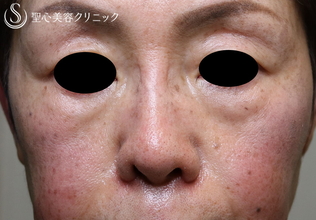 【70代女性・鼻の横幅】小鼻縮小（術後1ヶ月） After 