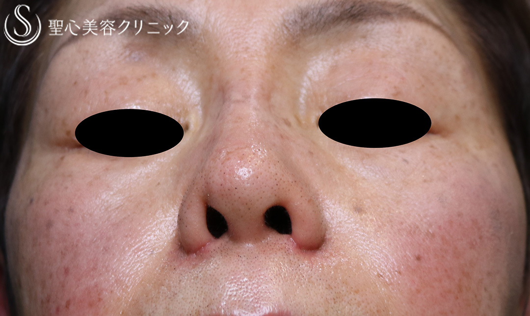 【70代女性・鼻の横幅】小鼻縮小（術後1ヶ月） After 