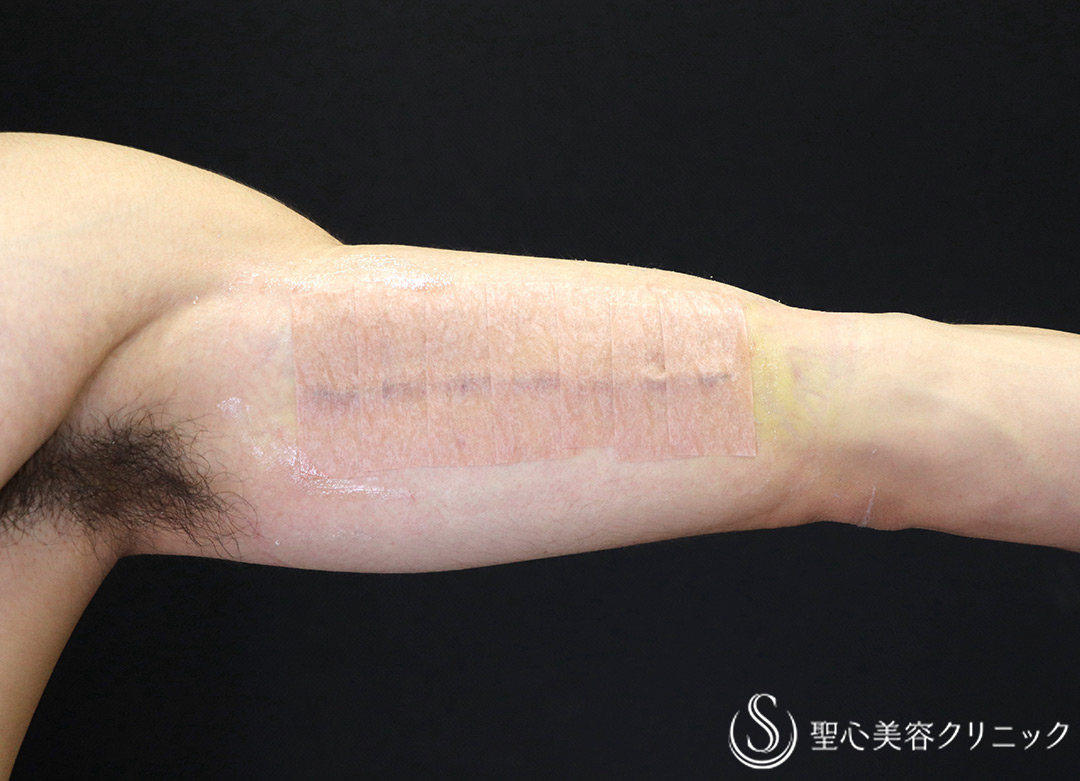 【20代男性・約11cmのタトゥー除去】タトゥー切除（1週間後） After 