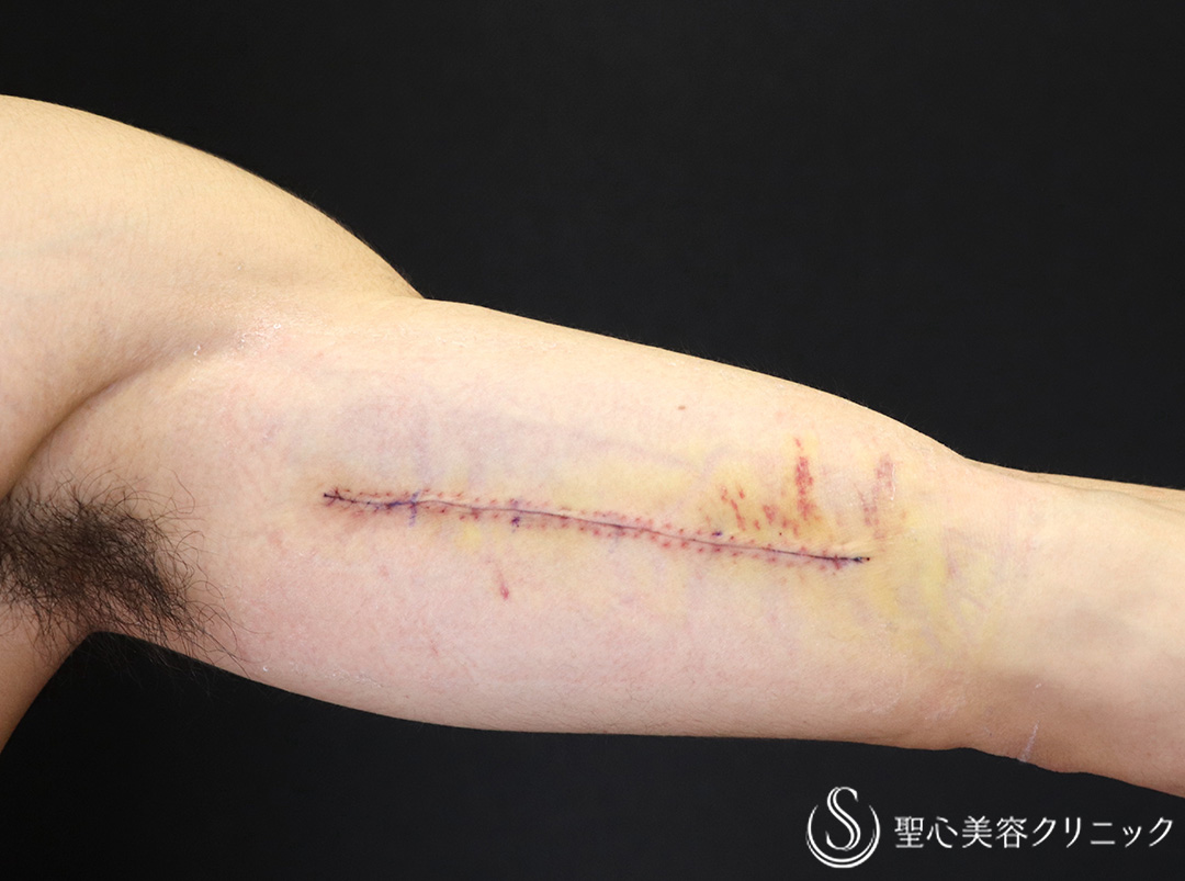 【20代男性・約11cmのタトゥー除去】タトゥー切除（1週間後） After 
