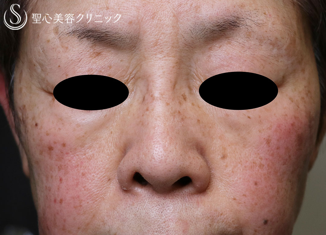 【70代女性・鼻の横幅】小鼻縮小（術後1ヶ月） Before 