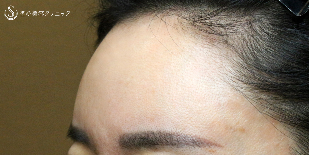 【50代女性・おでこの注入治療で若返り】プレミアムPRP皮膚再生療法（9年9ヶ月後） After 