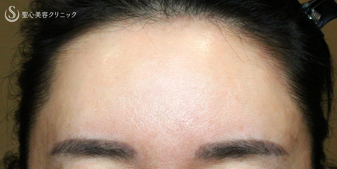 【50代女性・おでこの注入治療で若返り】プレミアムPRP皮膚再生療法（9年9ヶ月後） After 