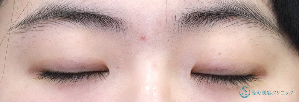 【20代女性・パッチリとして綺麗な二重に】 二重術（埋没法）：マイクロメソッド+α（1ヶ月後） Before 