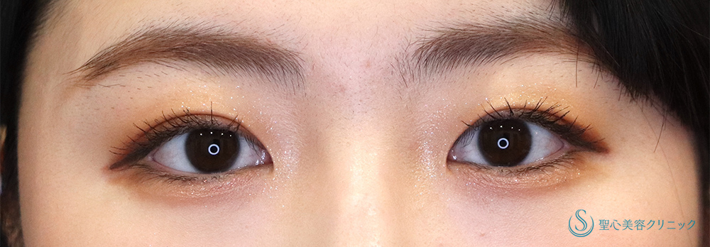 【20代女性・パッチリとして綺麗な二重に】 二重術（埋没法）：マイクロメソッド+α（1ヶ月後） After 