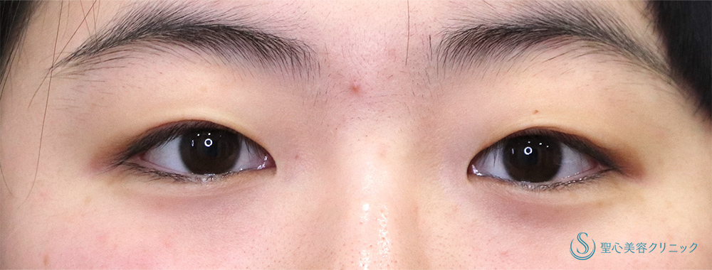 【20代女性・パッチリとして綺麗な二重に】 二重術（埋没法）：マイクロメソッド+α（1ヶ月後） Before 