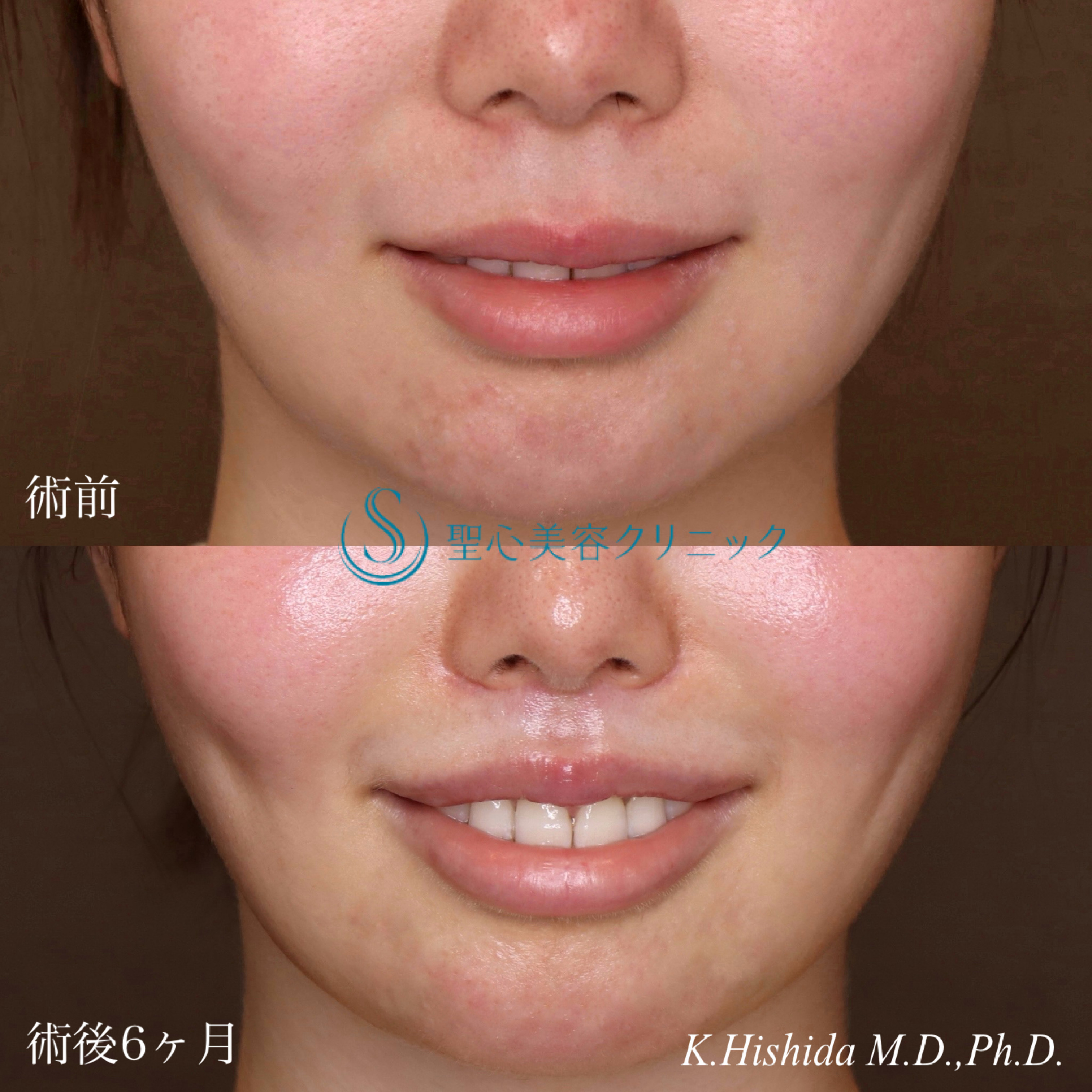 【20代女性・人中を短くしたい！】プレミアムリップリフト（プレミアム人中短縮術）（術後6ヶ月） After 