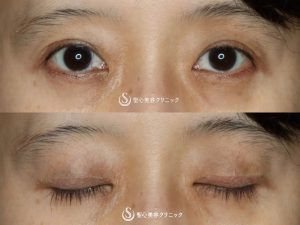 【50代女性・平行二重の大きな目に】目頭切開（術後3ヶ月） Before 