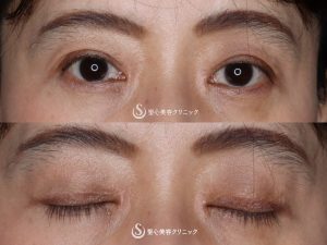 【50代女性・平行二重の大きな目に】目頭切開（術後3ヶ月） After 