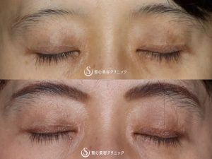【50代女性・平行二重の大きな目に】目頭切開（術後3ヶ月） After 