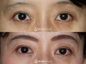 【50代女性・平行二重の大きな目に】目頭切開（術後3ヶ月） After 