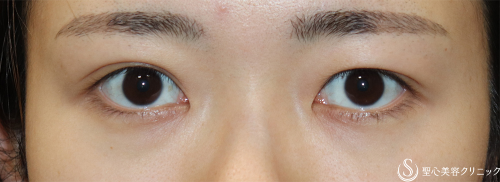 【20代女性・左右差を無くしたい】二重術埋没法（マイクロメソッド＋α）（1ヶ月後） Before 