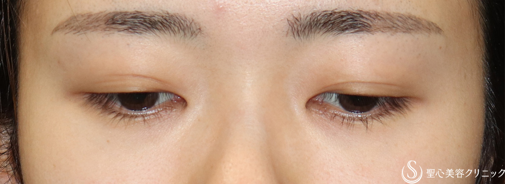【20代女性・左右差を無くしたい】二重術埋没法（マイクロメソッド＋α）（1ヶ月後） Before 