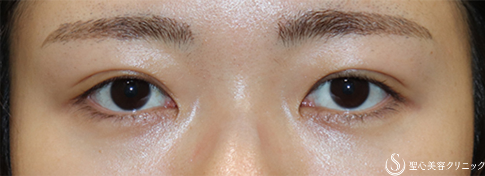 【20代女性・左右差を無くしたい】二重術埋没法（マイクロメソッド＋α）（1ヶ月後） After 