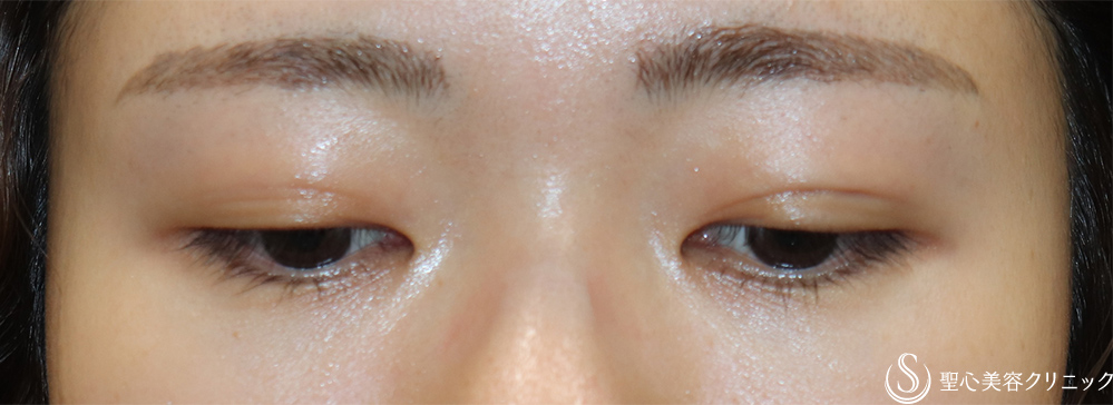 【20代女性・左右差を無くしたい】二重術埋没法（マイクロメソッド＋α）（1ヶ月後） After 